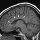 Cerebro afectado por síndrome de Susac. Foto: Wikipedia